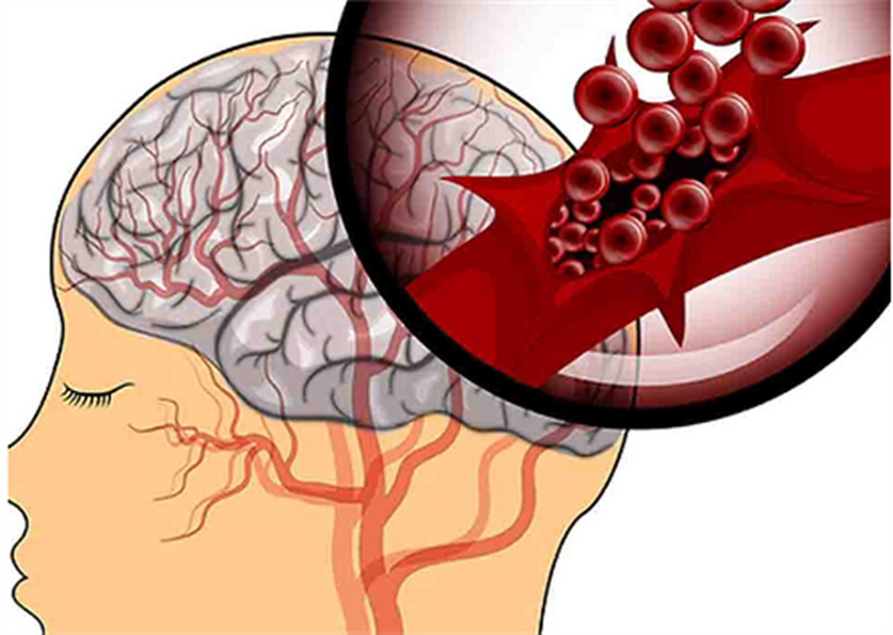 该如何预防脑出血71  脑出血是一种致死,致残率相当高的疾病,在我国