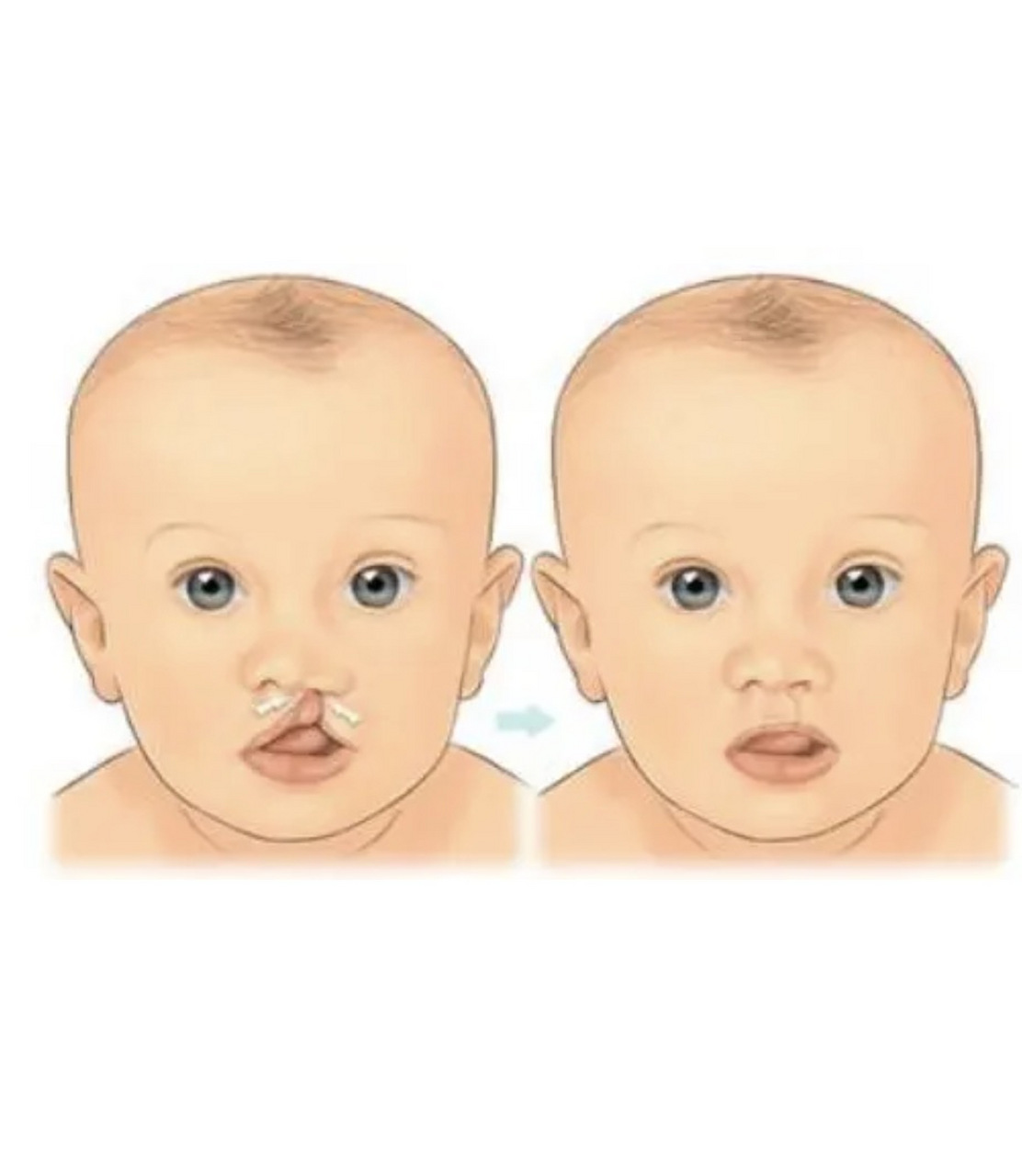 天生兔唇怎么办?