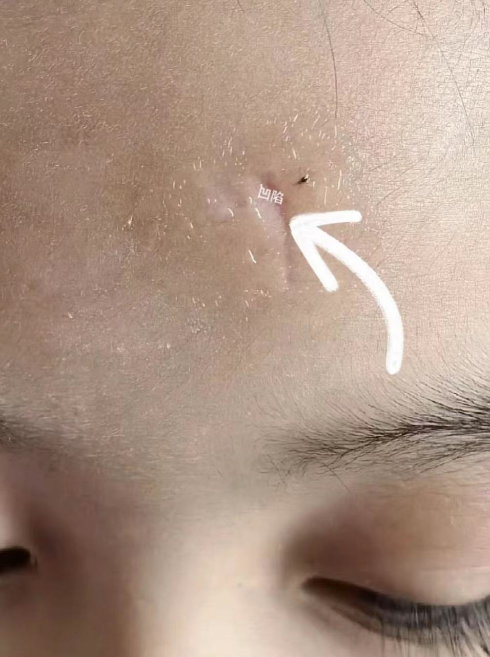 为啥有的瘢痕凸起,有的凹陷?该如何正确处理