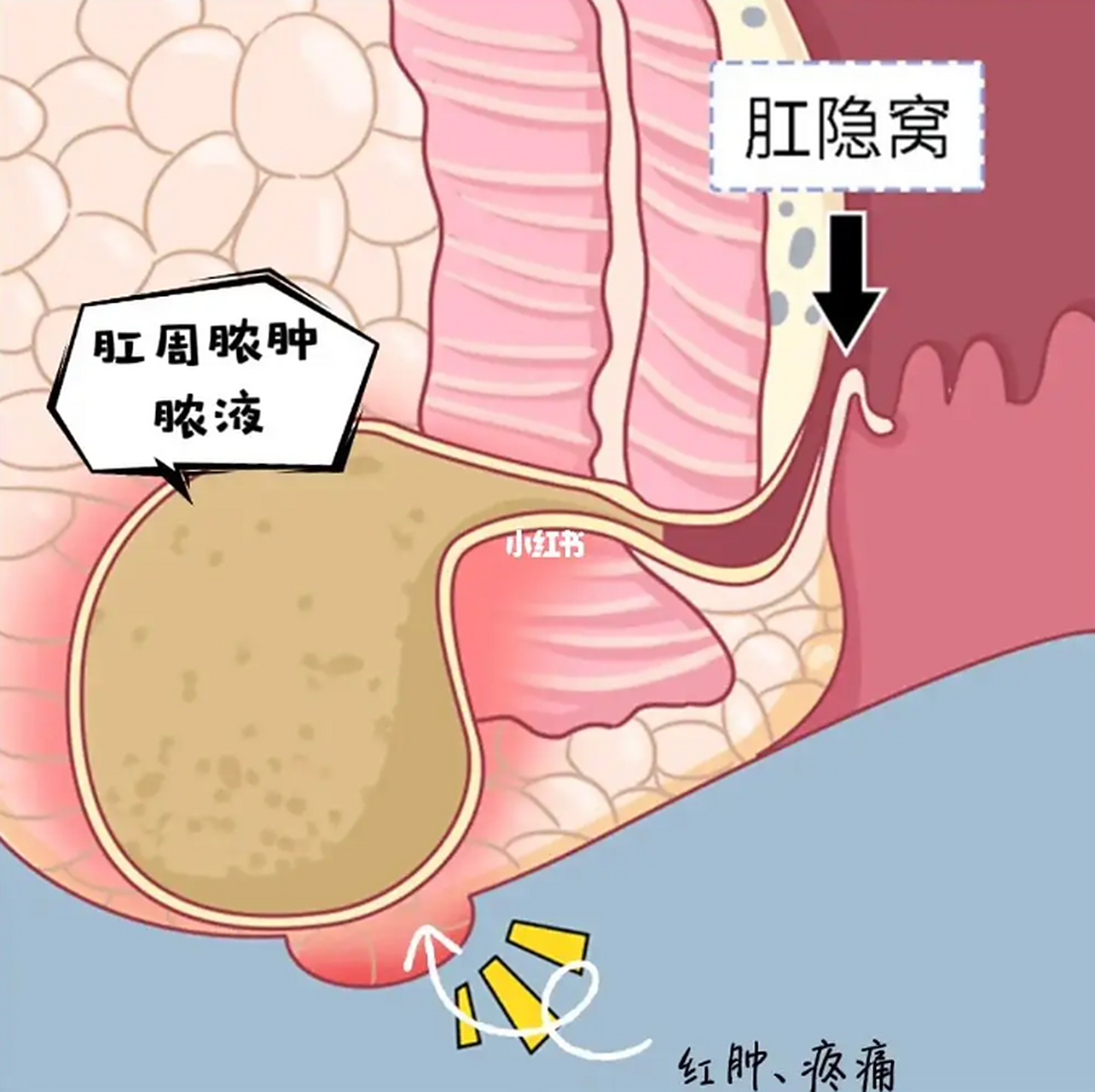 肛瘘手术能不能做微创的?这个要看情况!