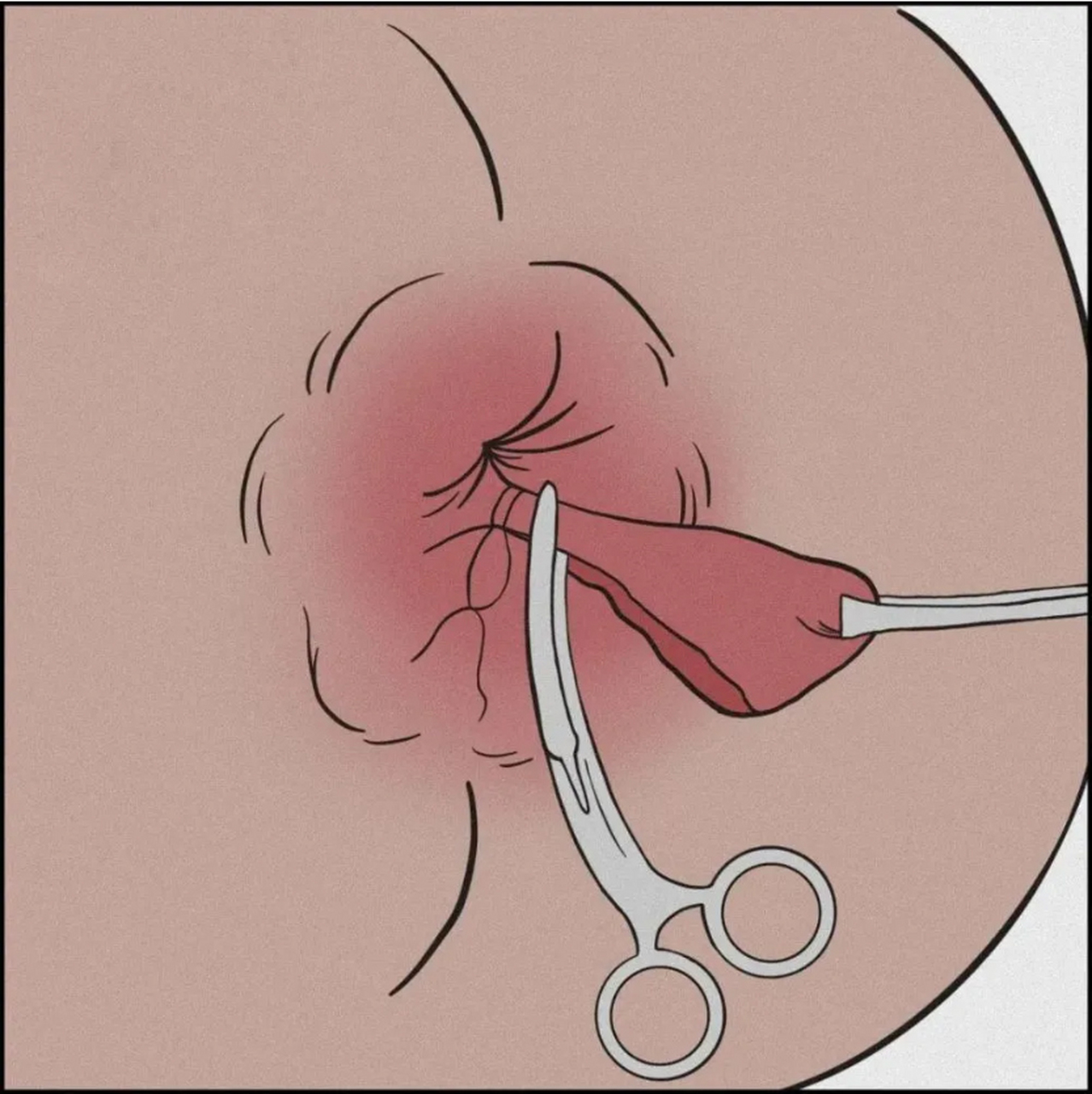 痔疮# #肛肠疾病#  很多人认为痔疮是"肉",要割掉还挺舍不得.