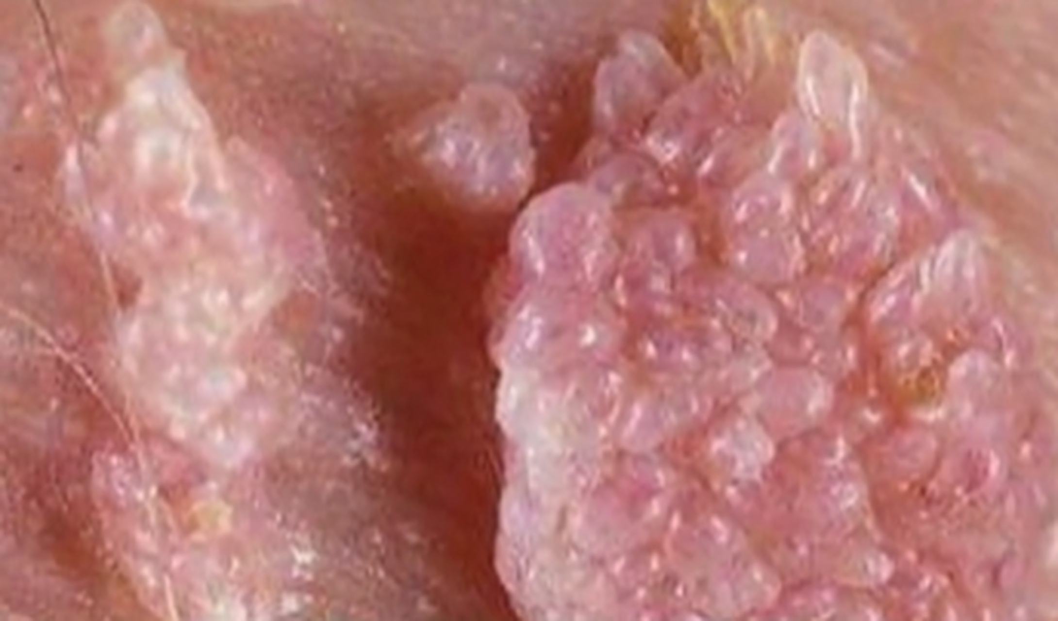 大家好,我是北京三甲医院曹梅医生,尖锐湿疣是一种性传播疾病,感染性