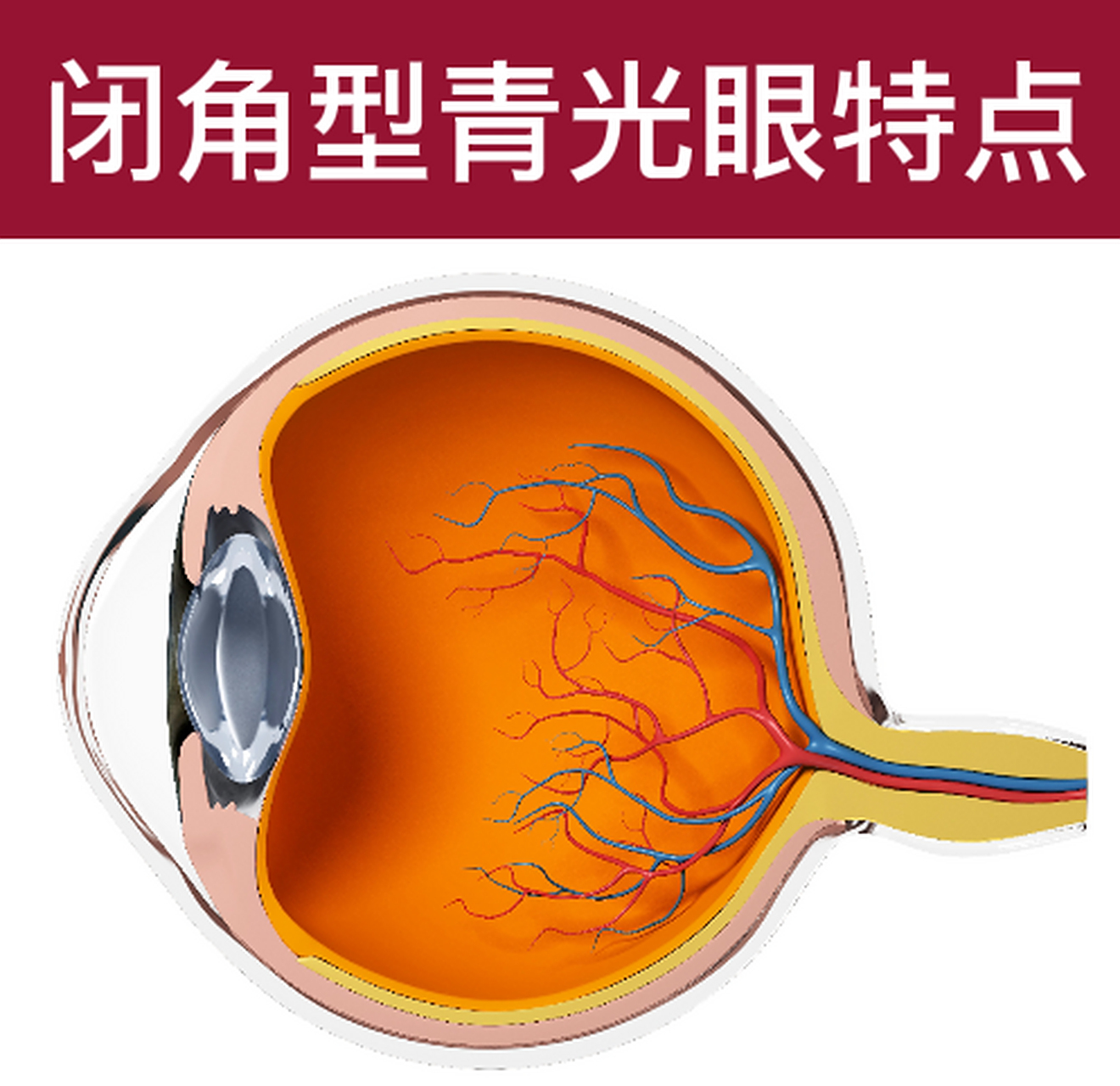 闭角型青光眼的特点中医有个讲法叫头重如裹,头如斧劈,这是闭角型
