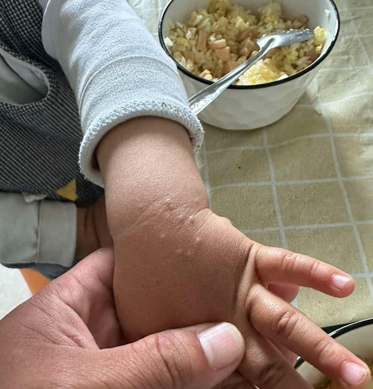 宝宝手上长了这么多这个小疙瘩,你们有人知道是什么吗