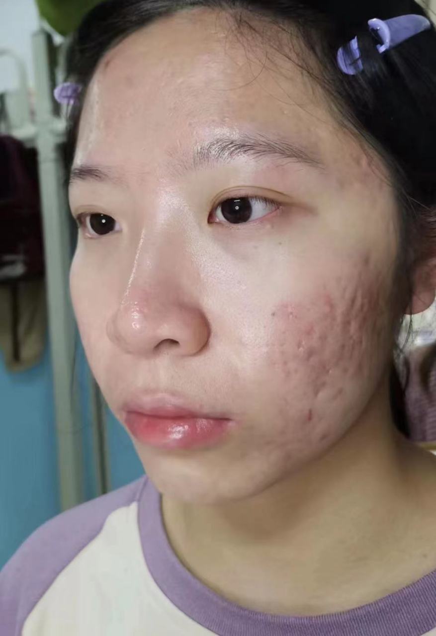 痘疤是很多人都非常苦恼的问题,尤其是对于曾经长过痘痘的人来说,留下