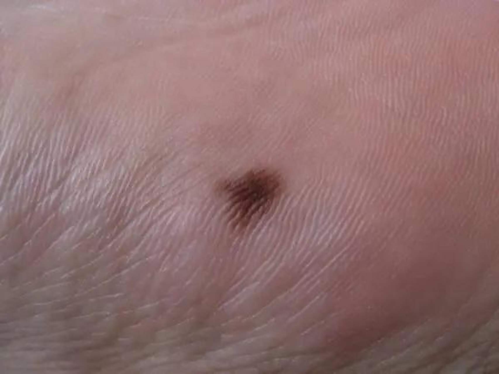 昨天晚上,我帮老婆捏脚,结果在她脚底发现了2颗痣,我记得以前没有的