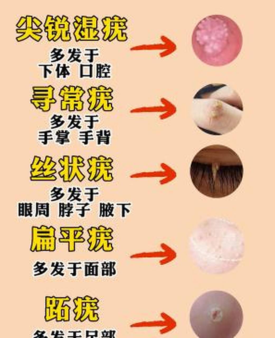 hpv感染引起的疣体 长什么样子? 快来看看你身上有吗?