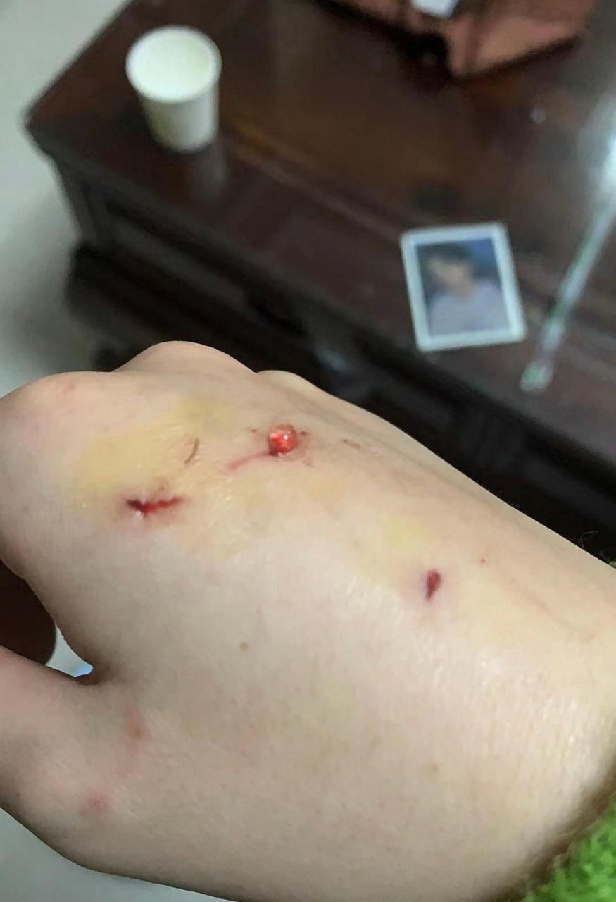 网友:养了四五年的狸花猫,把我咬成这样,没想到养了个白眼狼,丢了吧又