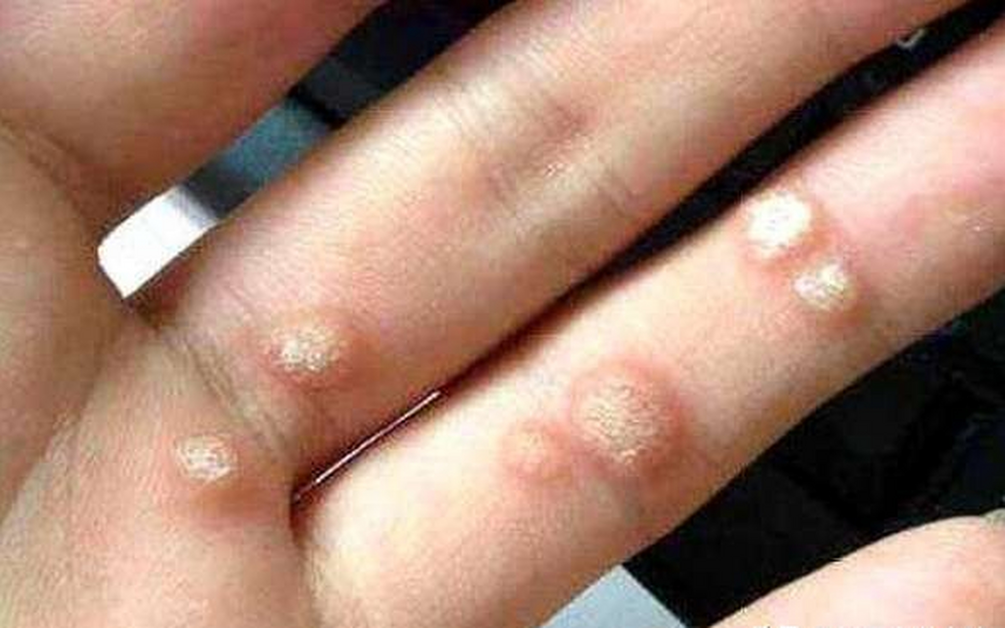 手上,手指上长小肉粒,摸起来又硬又粗糙,类似下图这种的,基本上就是