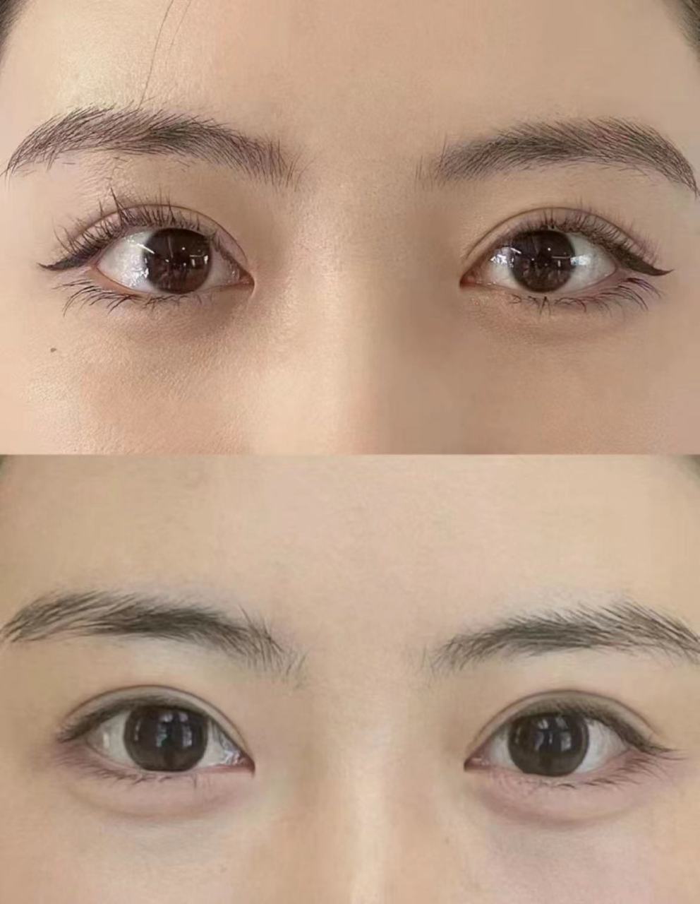 卧蚕填充用什么填 最好#医美科普挑战赛#  卧蚕是指眼睑内侧部分因为