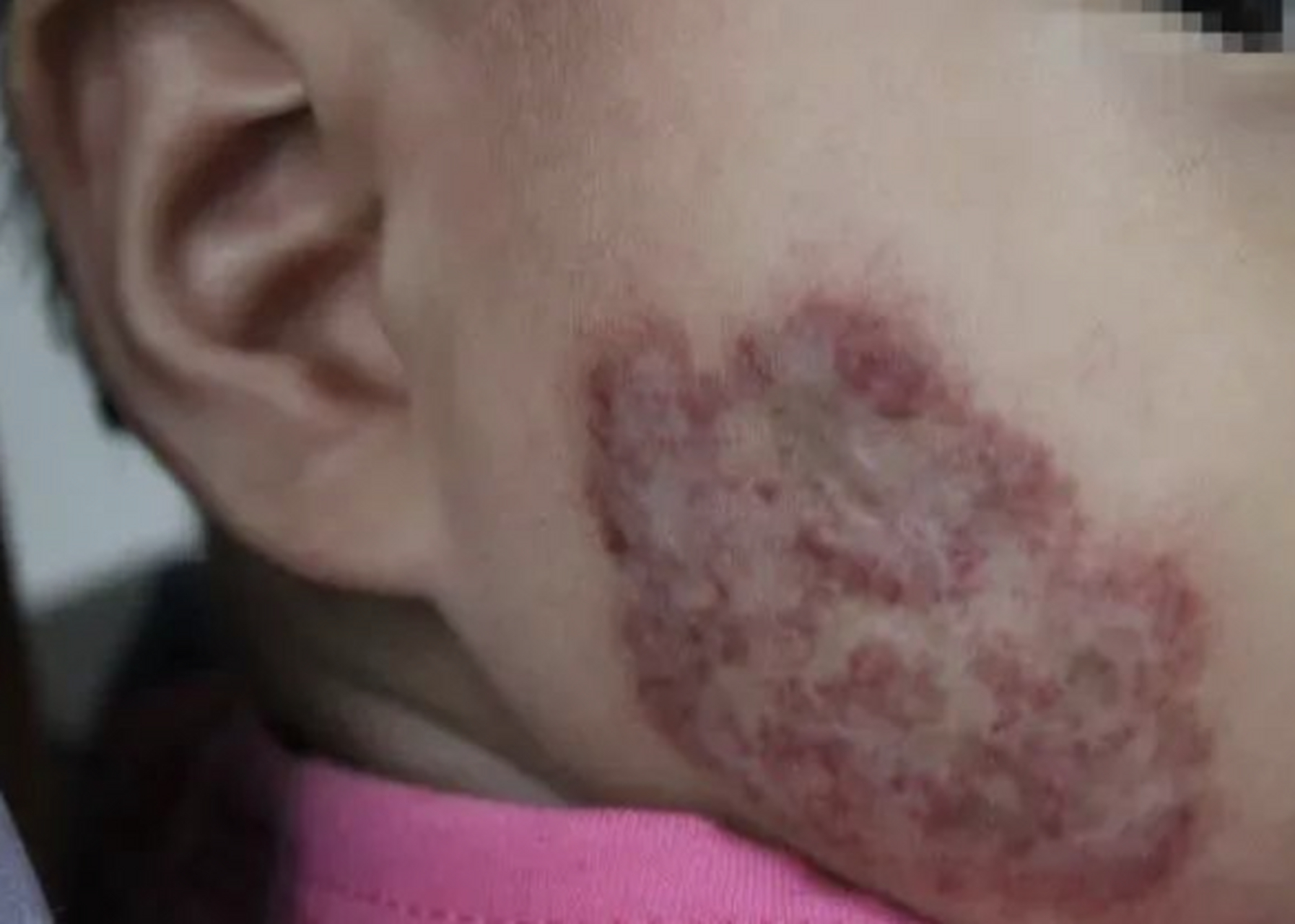 血管瘤如果生长在孩子的脸上,其危害也是很大的,不仅会影响孩子的