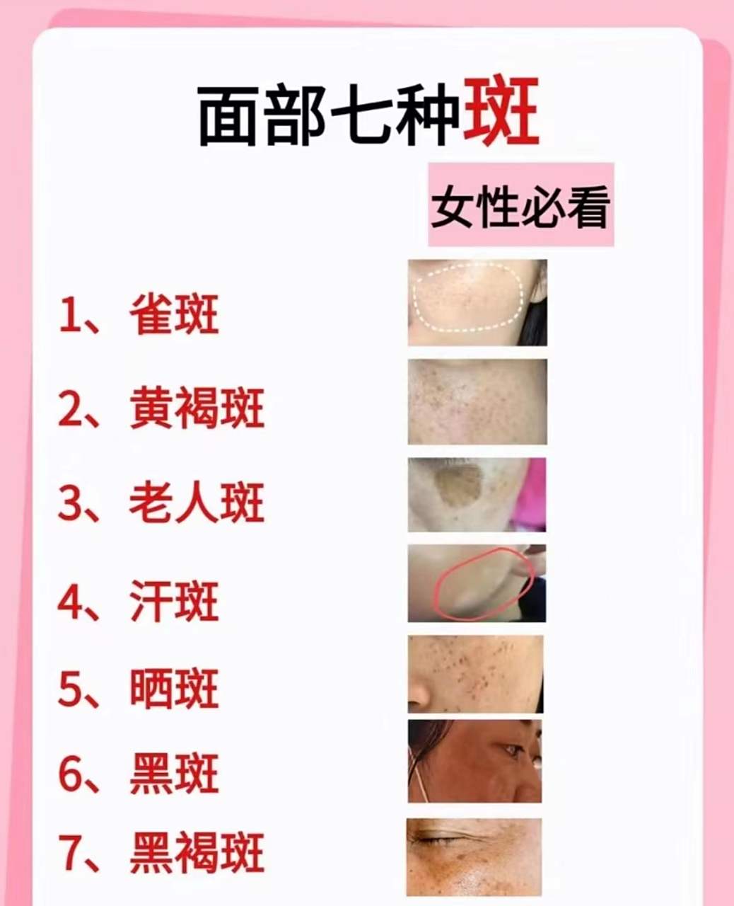 雀斑:多呈现为小而散乱的棕褐色斑点,常见于面部. 2.