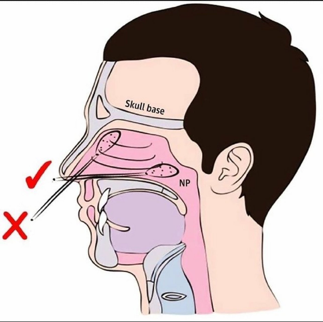 鼻咽拭子采集部位图片图片