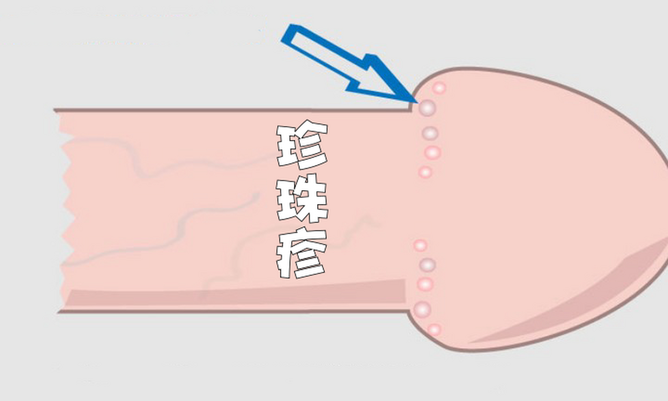 冠沟处长白色疙瘩图片