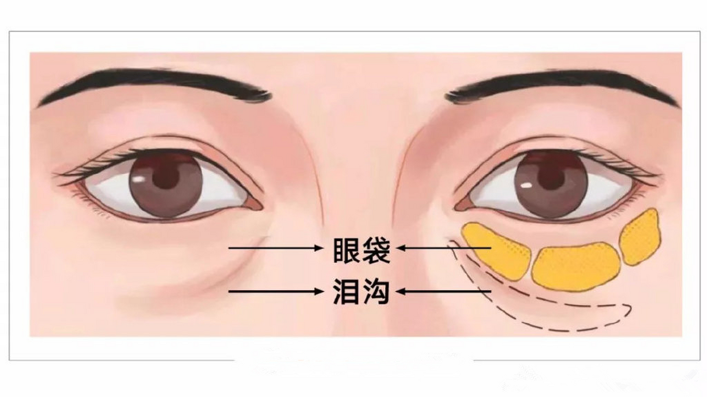 最简单的检测方法:从侧面看,眼袋是凸出感,泪沟则是凹陷