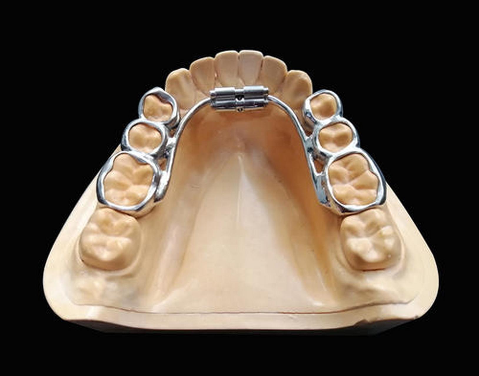 牙齿正畸时佩戴的扩弓器一般戴多久合适呢#牙齿正畸#牙列不齐 扩