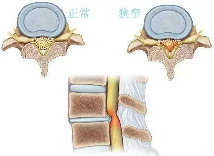 有网友咨询,自己是腰椎管狭窄,问能否通过中医推拿按摩的方式来进行