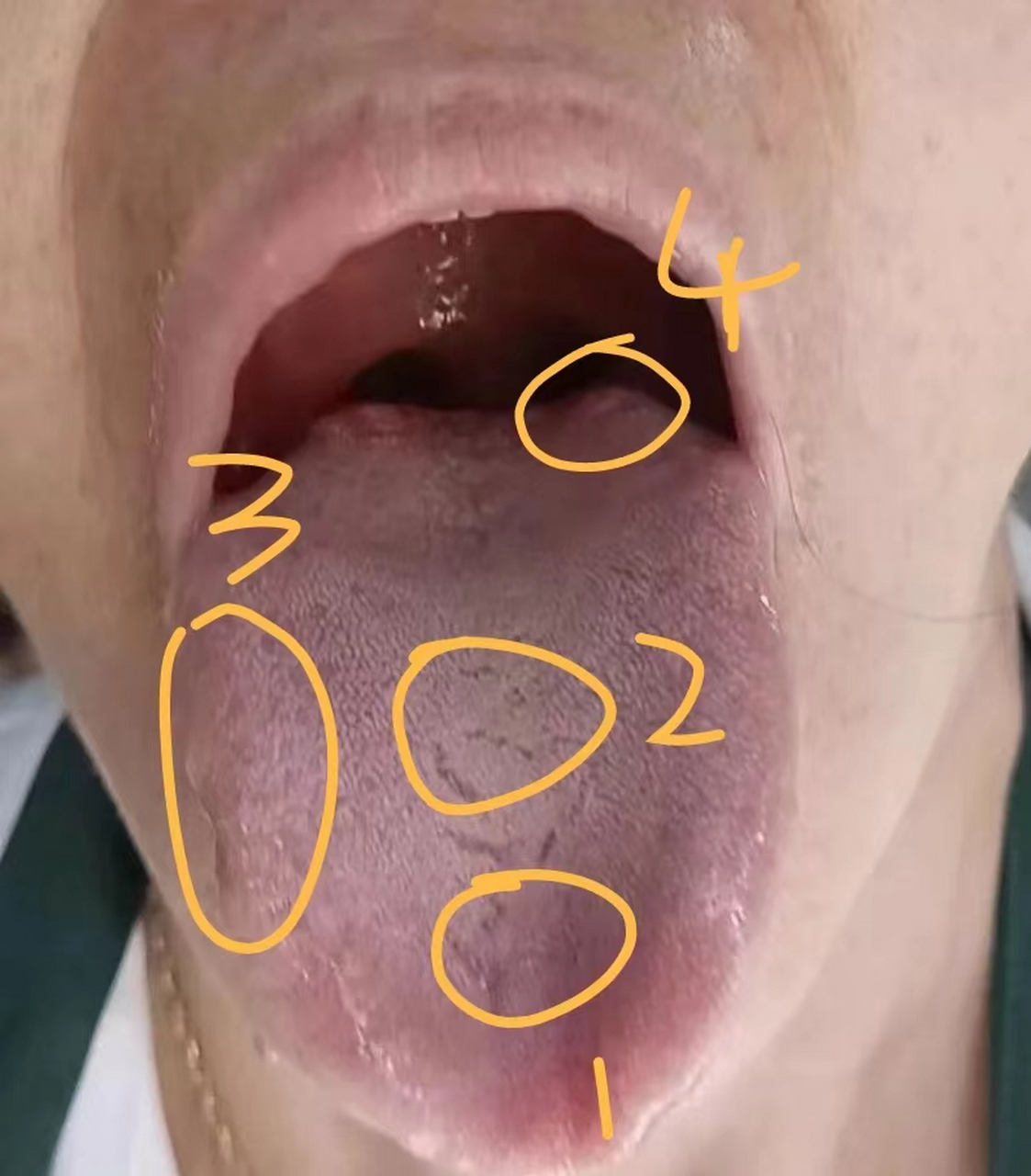 1:舌前肺区凹陷,肾区凹陷的,说明气不足,会出现乏力,困倦,劳累后可能