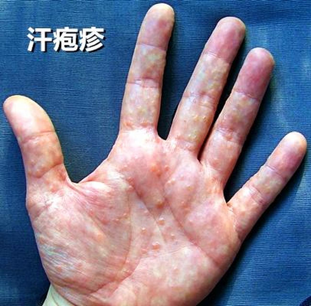 汗疱疹是由于皮肤受到过度热量和潮湿的影响而引起的