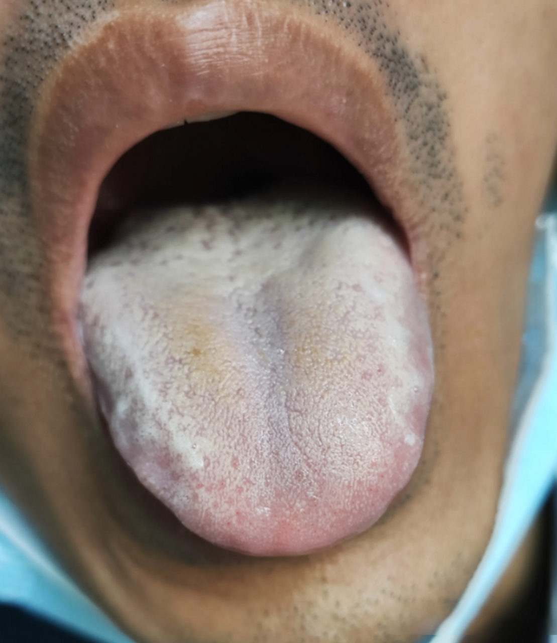 分不清楚寒和热,来看看这个两个舌头,寒热一眼可判  通常情况下舌质红