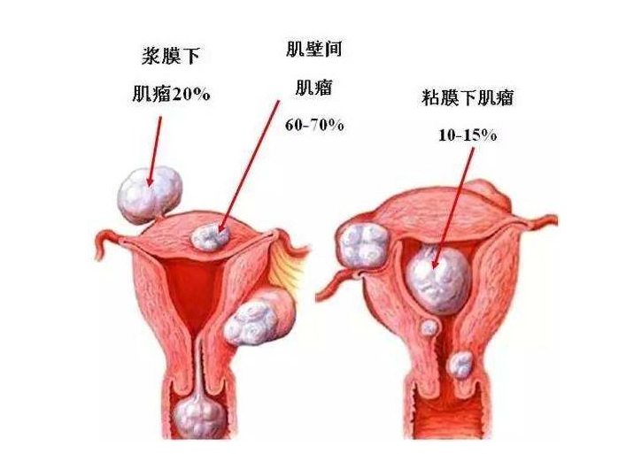 子宫前壁肌瘤的位置图图片