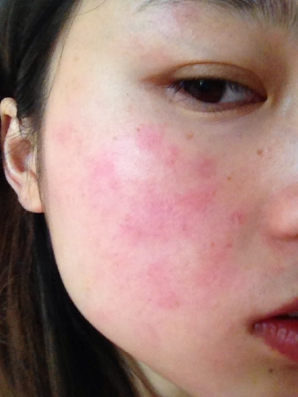 当皮肤屏障受损时,需要进行适当的调理和保护.