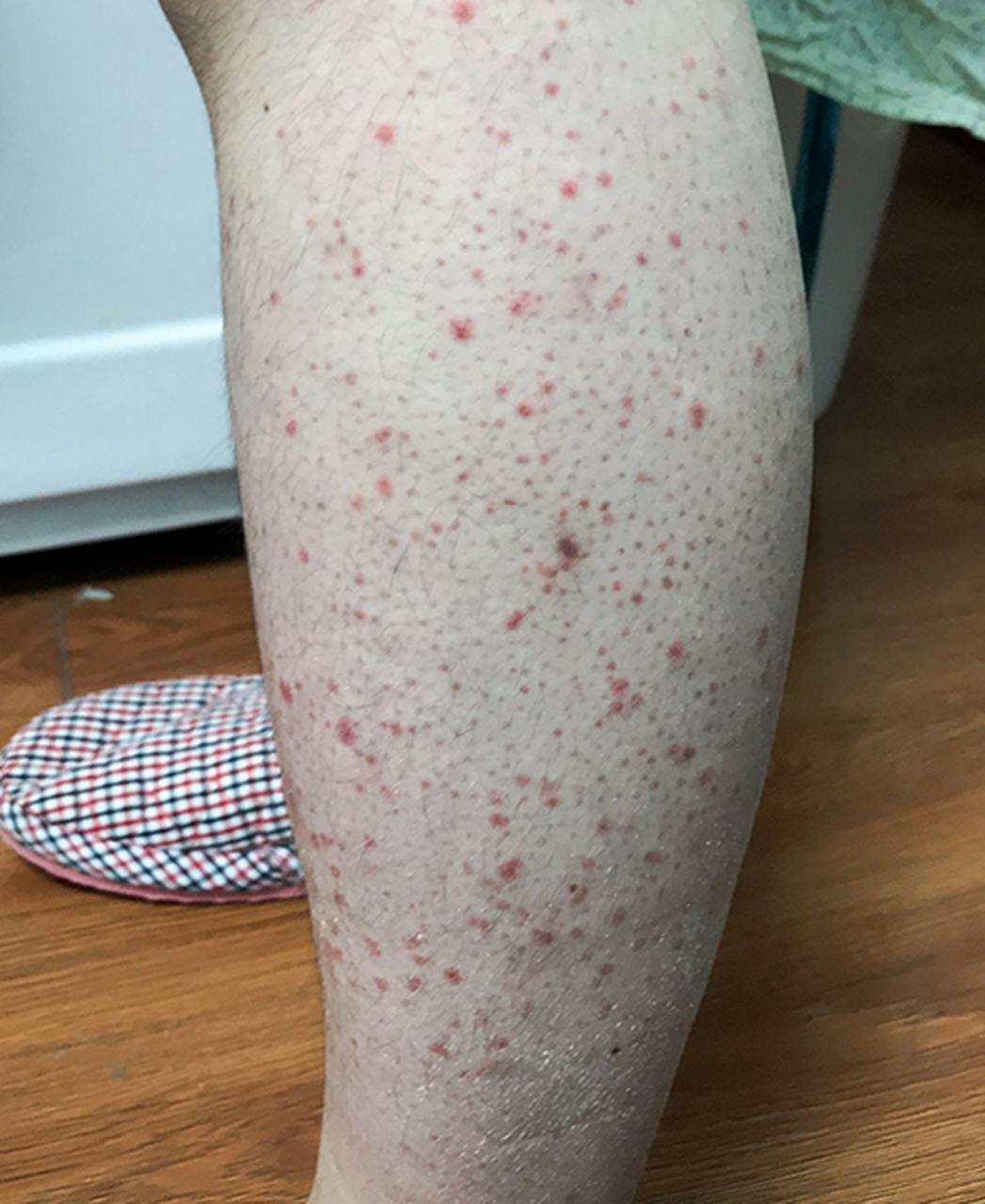 怎么判断是不是过敏性紫癜?