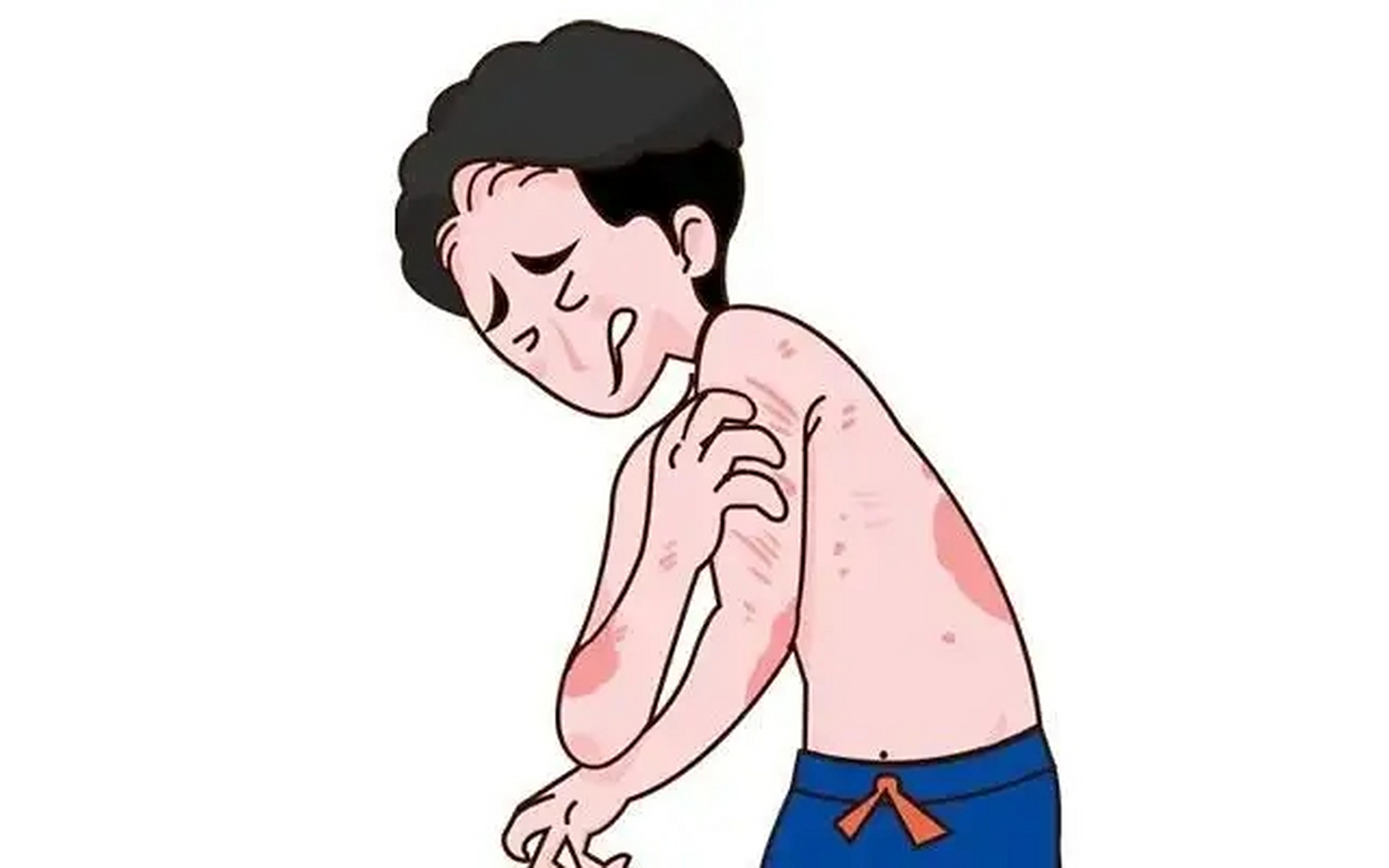 不宜泡温泉人群 对于静止期及消退期的牛皮癣患者,温泉浴可去除鳞屑