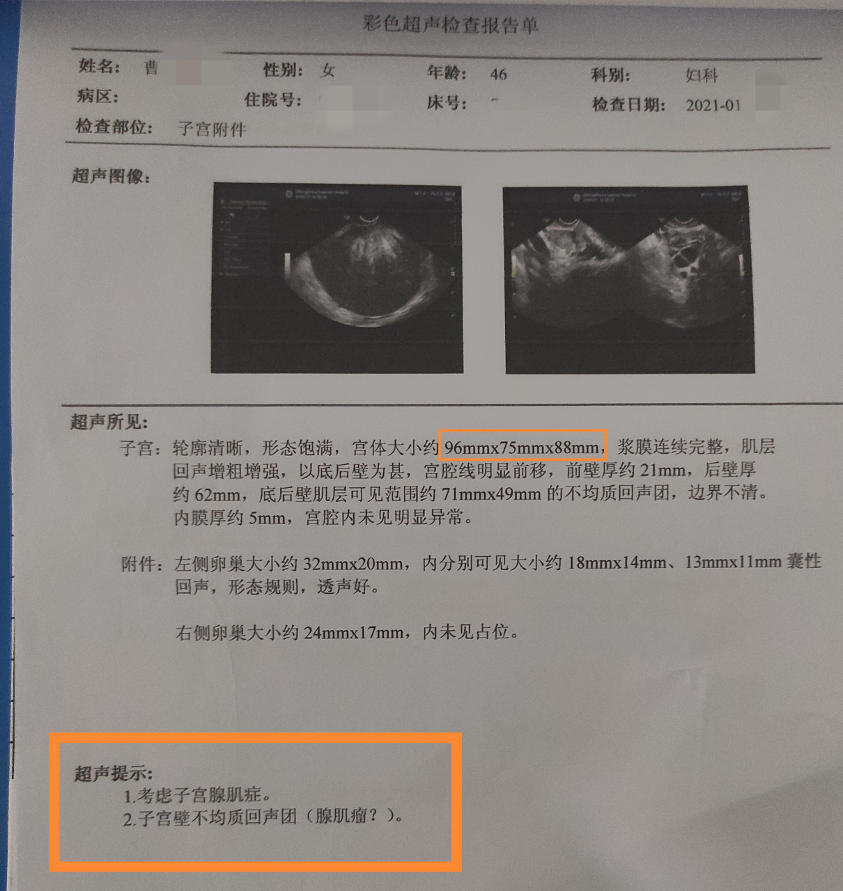 上了曼月乐,一个月后查彩超,没有发现环?