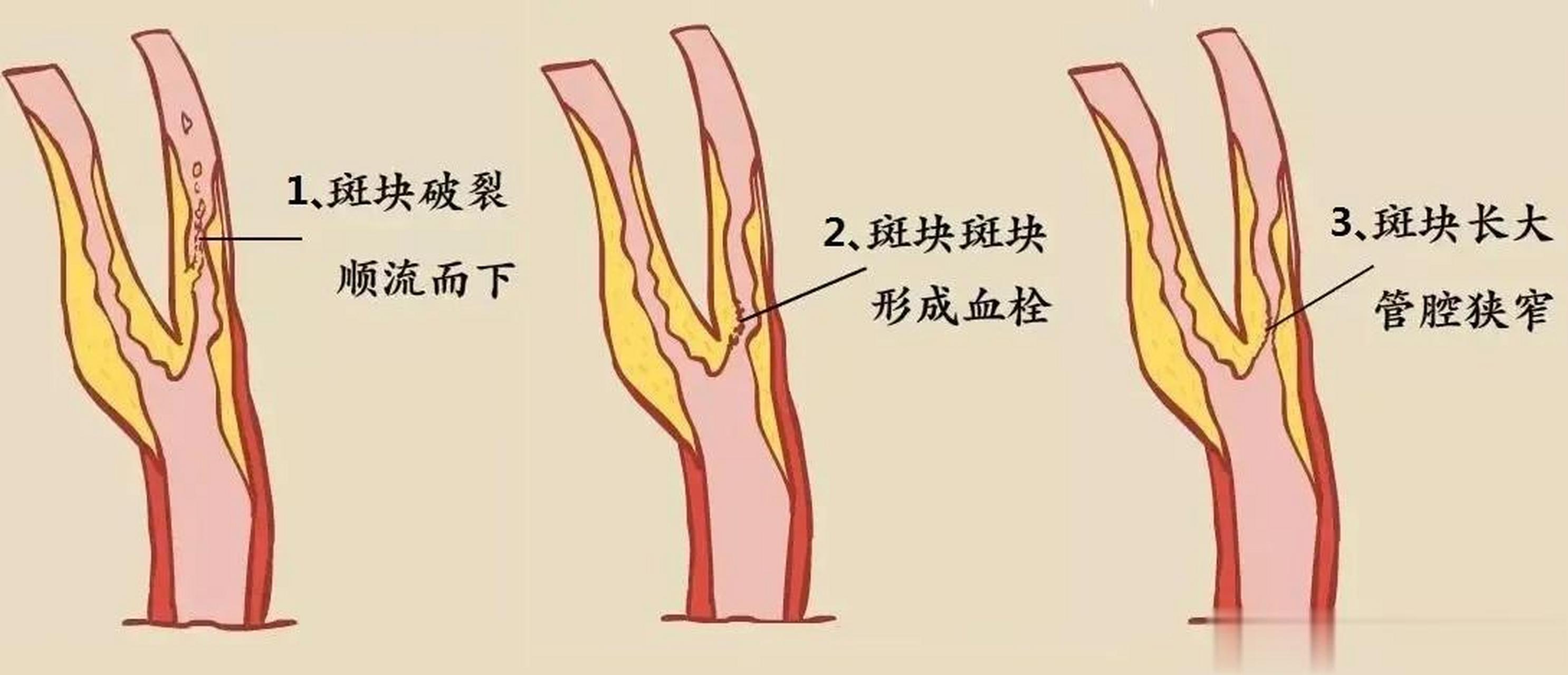 人一过40就很容易查出颈动脉斑块,这是因为步入中年后,人的身体开始走