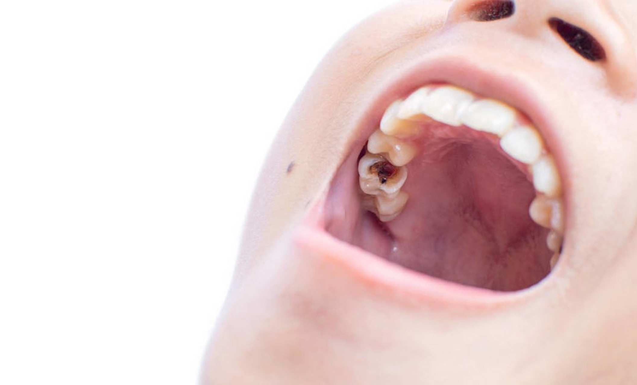导致牙齿发育不良 3引起牙髓炎  三,4个小妙招或能预防蛀牙  1