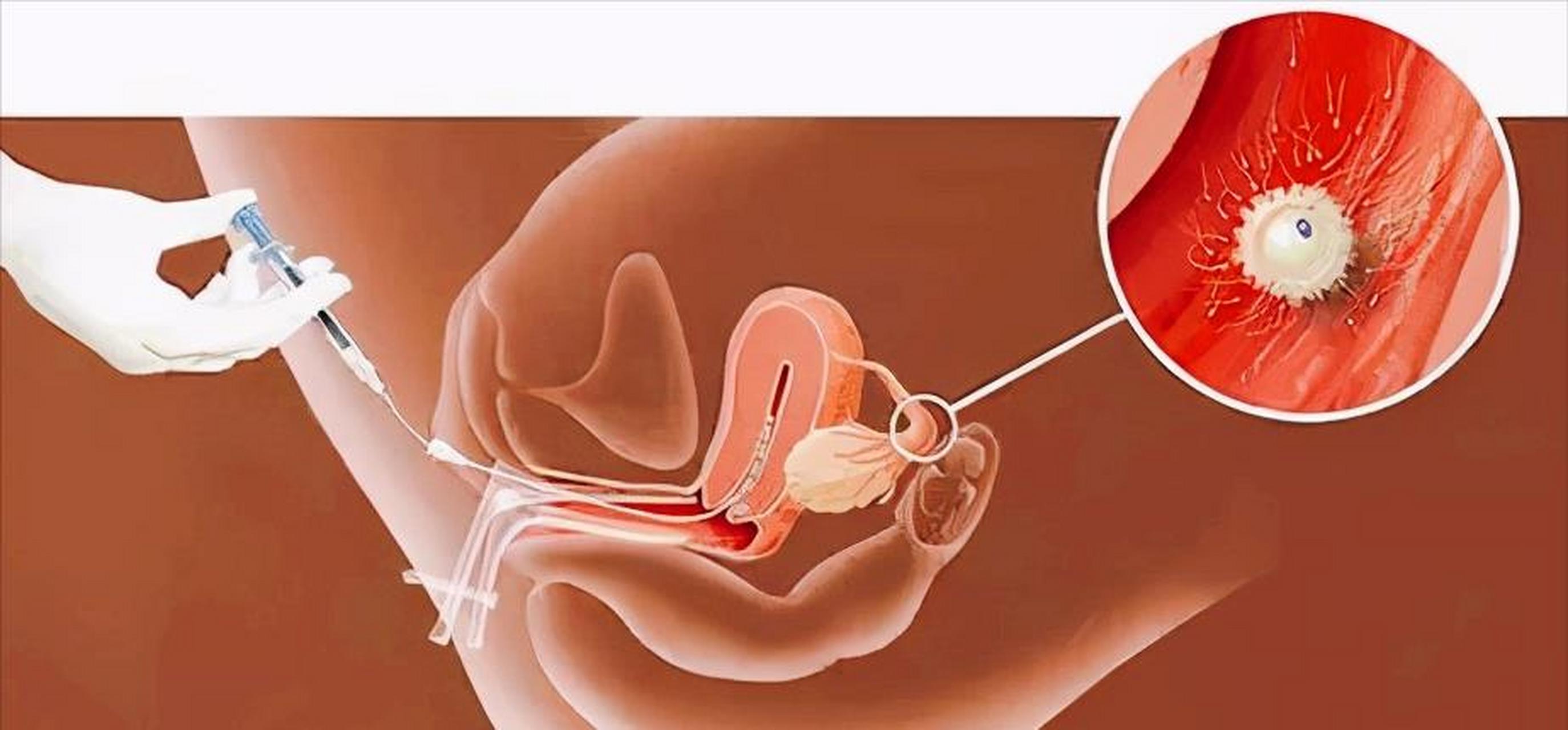 人工授精其实比较简单,首先就是男方自己通过手淫把精液取出来,然后