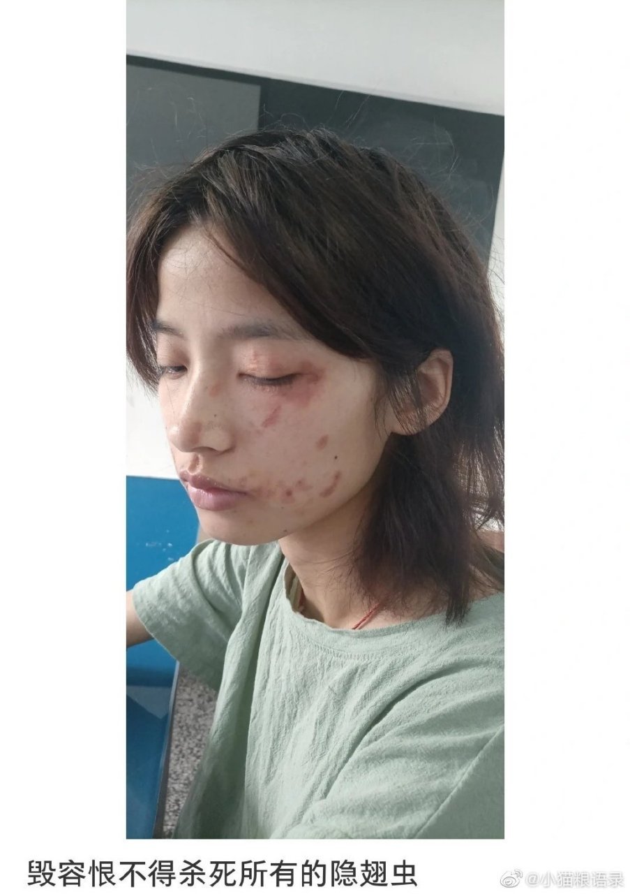 刚看到,有人说自己被隐翅虫飞到脸上,然后脸就变的"贼好看".