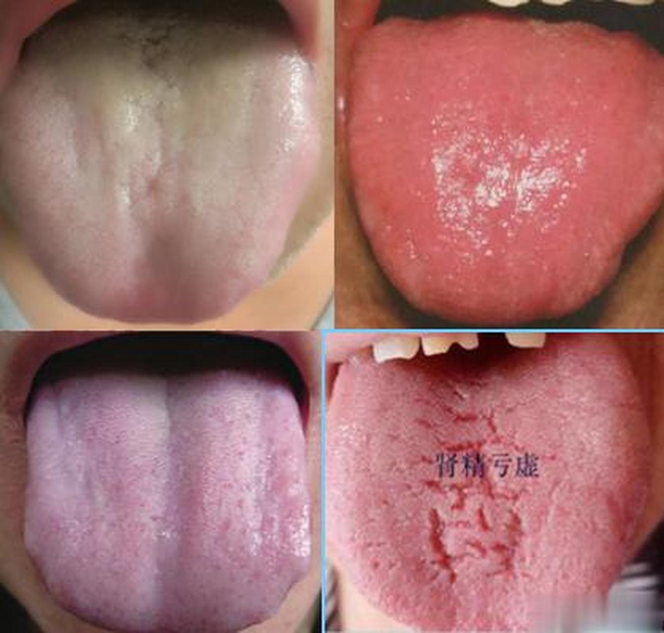 舌淡红——正常舌鲜红——实热舌淡白——虚寒舌绛红——里热舌紫暗