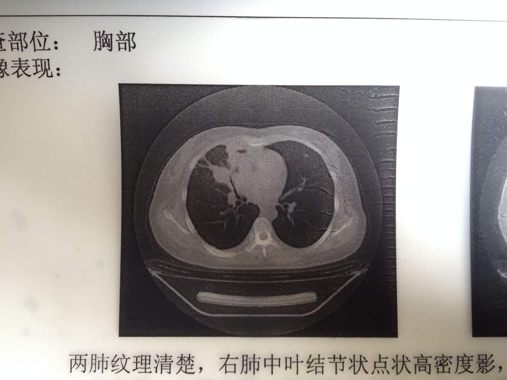 1,纤维灶(一般是结节) 2,钙化灶(一般是良性) 3,粟粒性肺结节(多是