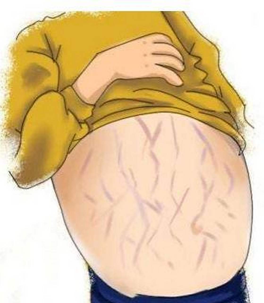 腹部膨隆,可见移动性水浊音 肝腹水患者一般会腹部隆起,看起来比较