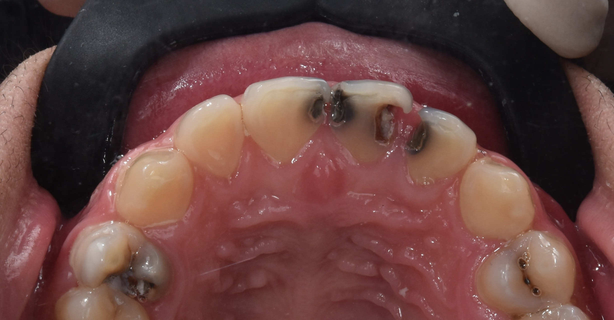 张院长为其进行舒适微创治疗后,采用全瓷冠修复患牙.