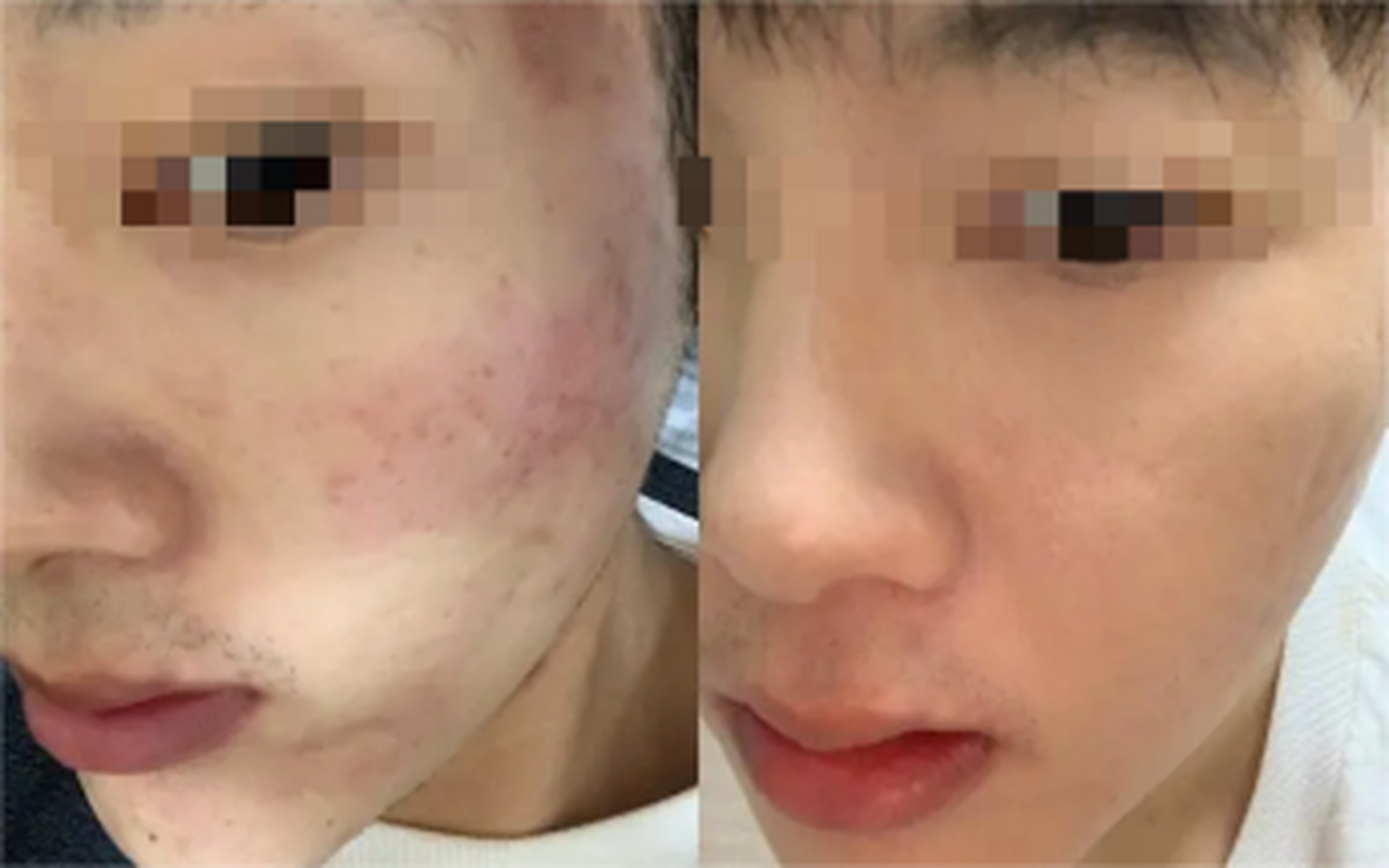 点阵激光祛痘印几次才有效果  无数爱美者深受痘印的困扰.