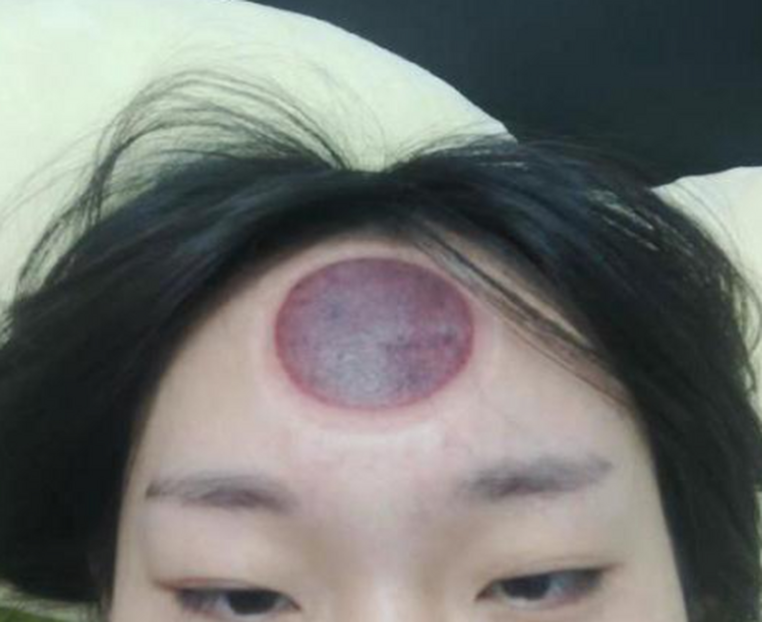 我头疼,我妈说这样拔罐有效果,真的可以吗? #拔火罐