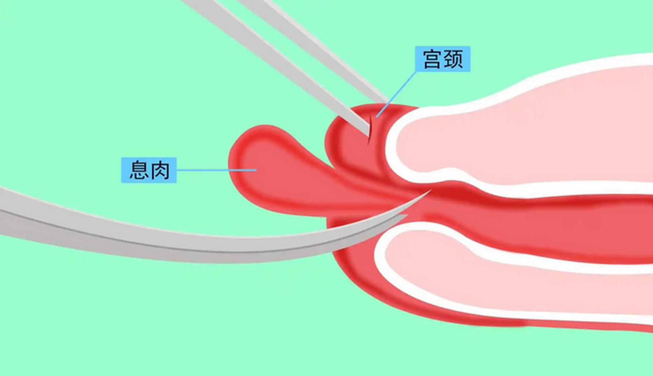 宫颈息肉要不要切除?