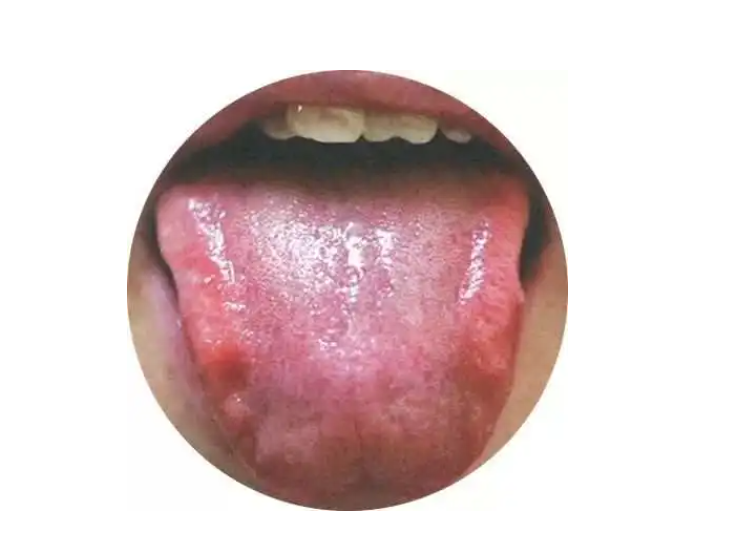 舌体瘦小,舌尖发红,舌边有齿痕