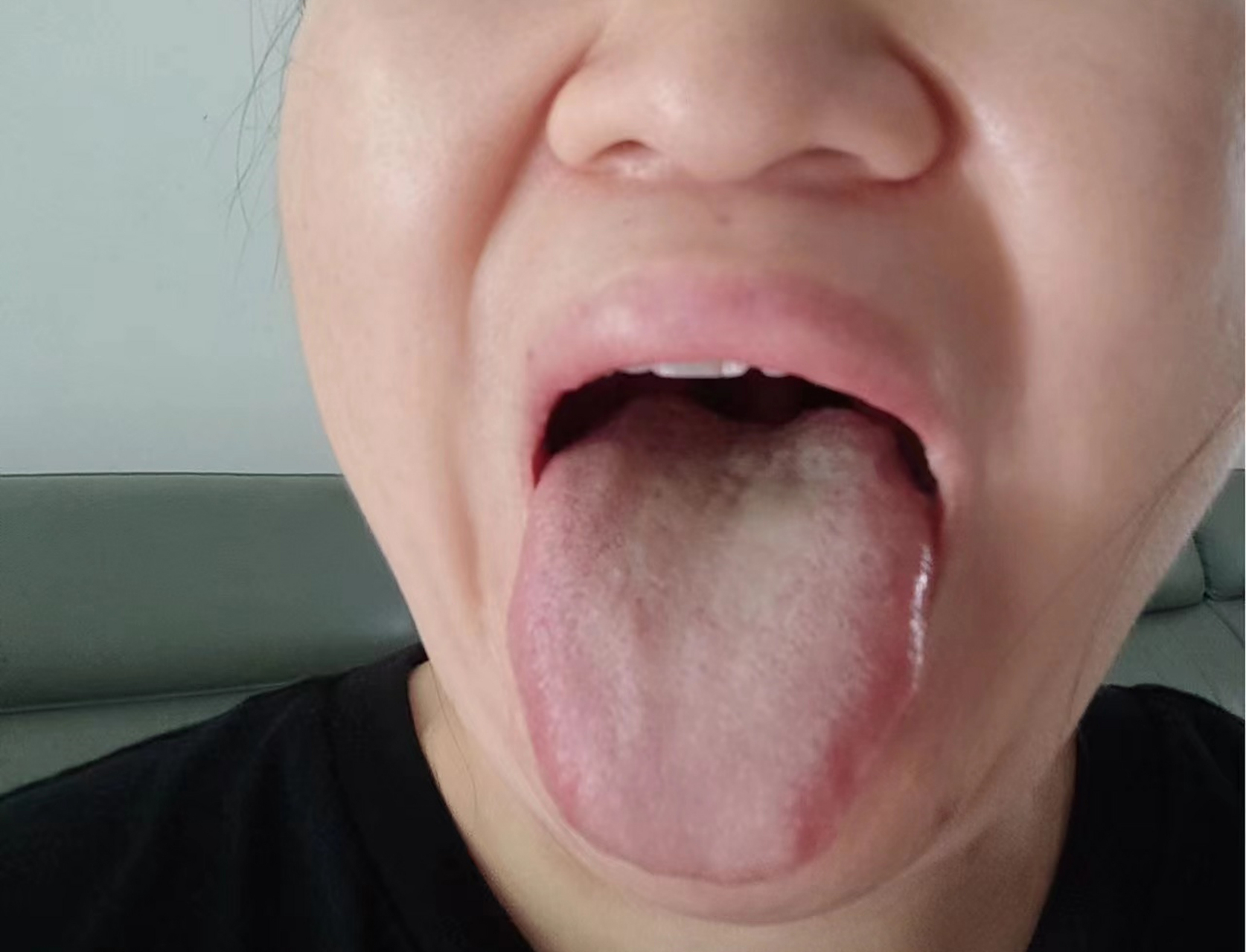 舌边鼓胀发红,肝火旺盛,肝气不舒,急躁易怒,两肋胀痛,肋下胀痛,心肝火