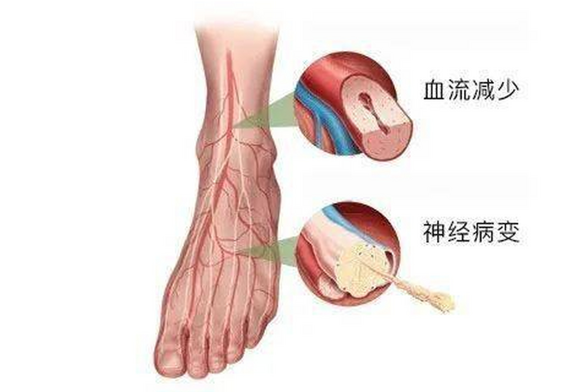 糖尿病神经病变检查图片