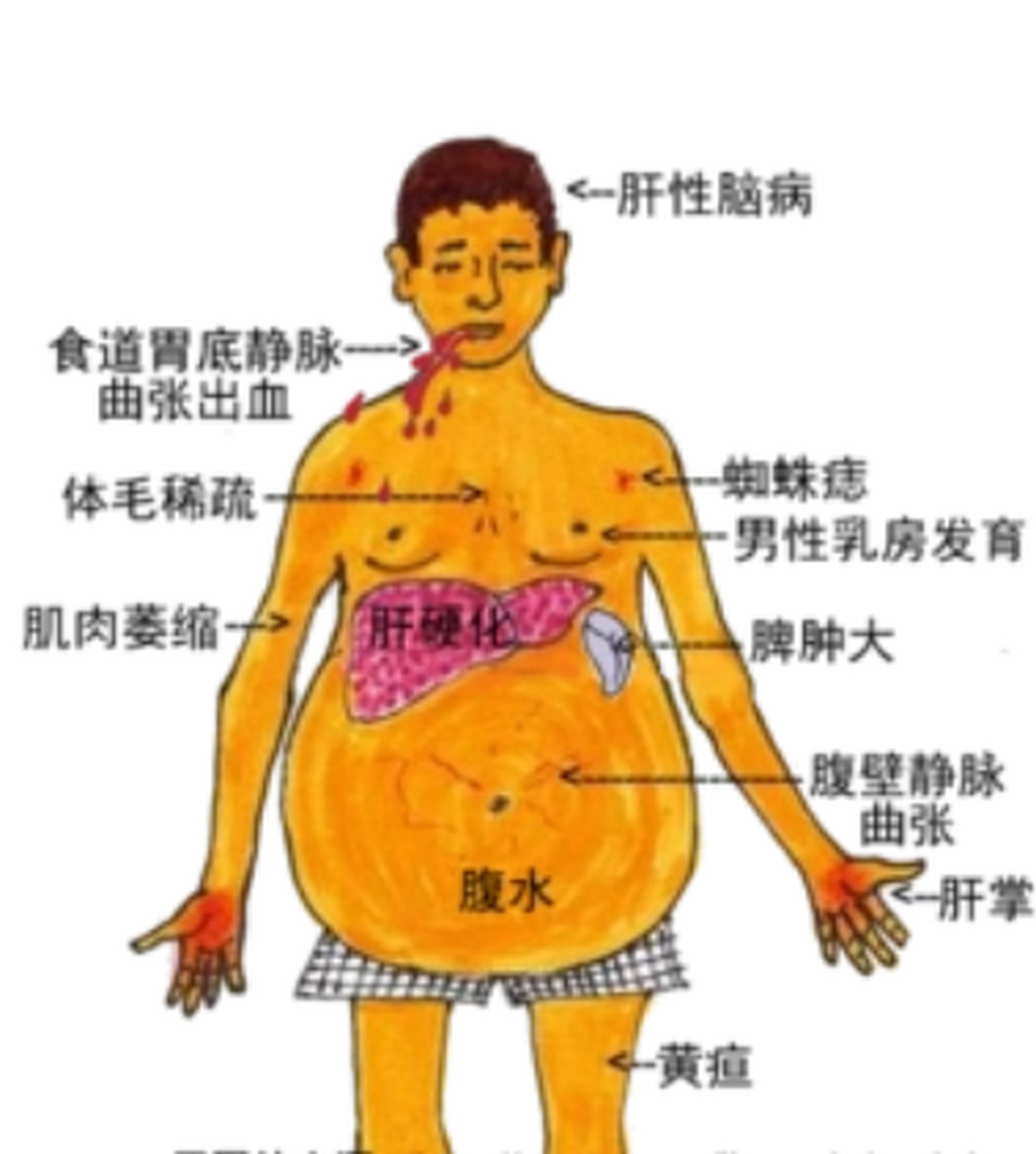 肝硬化怎么治的效果不错?3种情况4个办法一看就懂!  一,肝功能稳定.