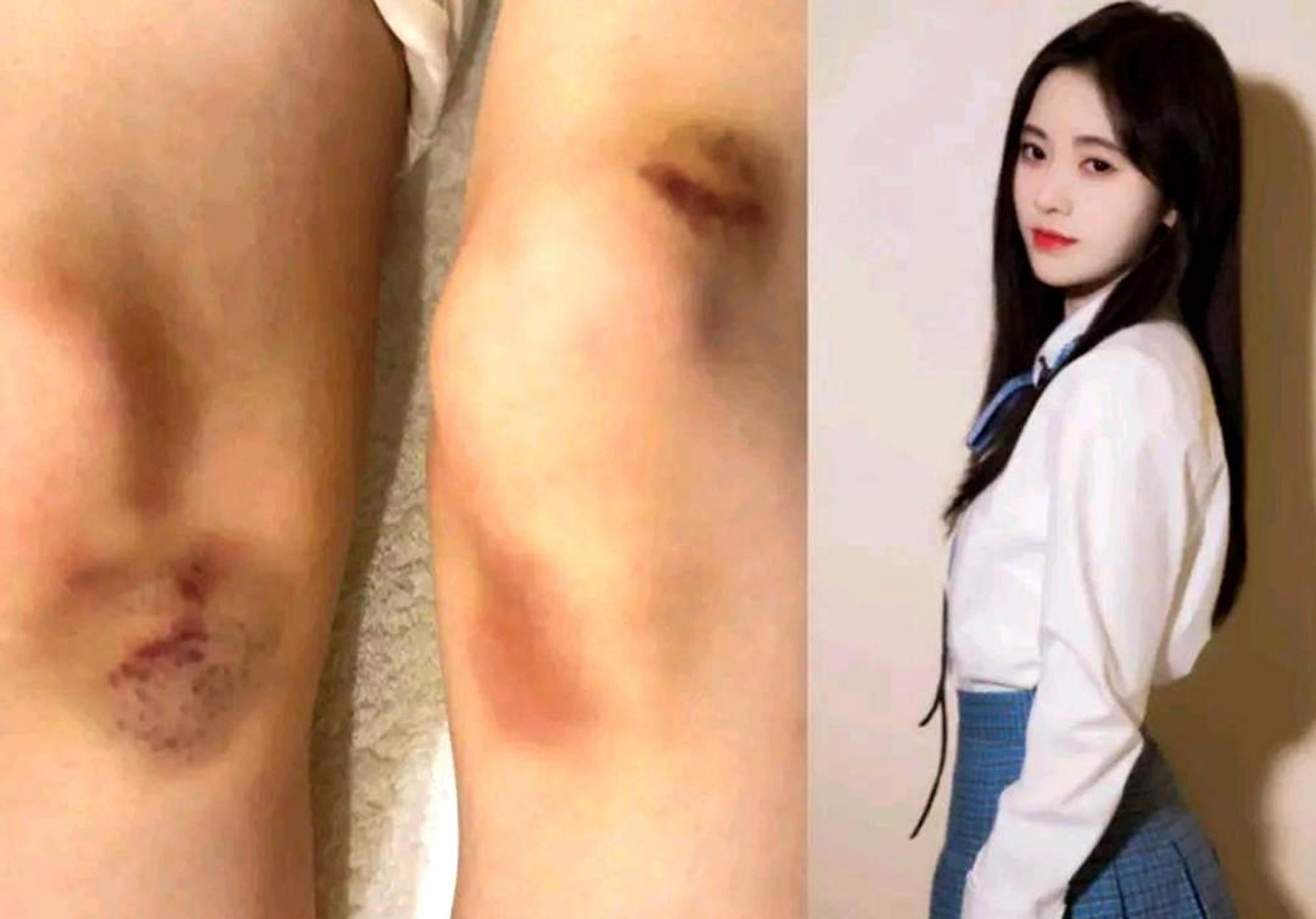 鞠婧祎晒出自己膝盖受伤的照片,瘦弱的一双膝盖上,有好几处大的淤青和