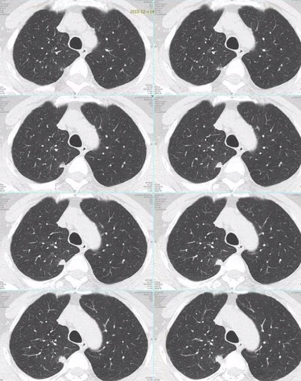 良性肺结节ct图图片