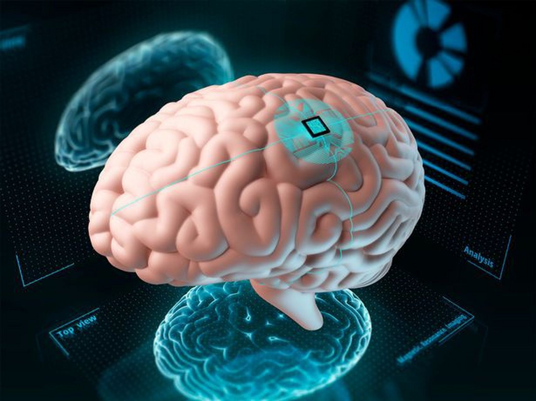 大脑芯片植入技术图片