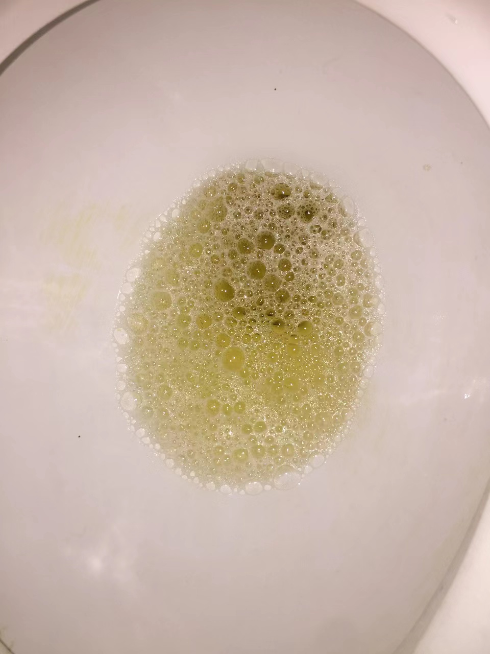 尿蛋白高是慢性肾脏病最常见的表现之一,它会让肾脏逐渐出现一系列