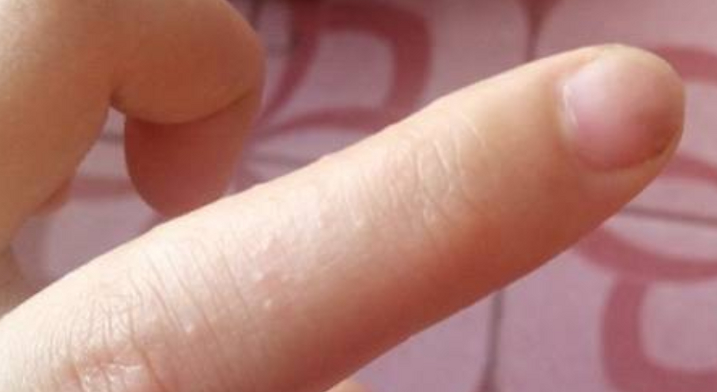 手上长透明小水泡,是上火吗?多数人都想错了,或是它在作怪