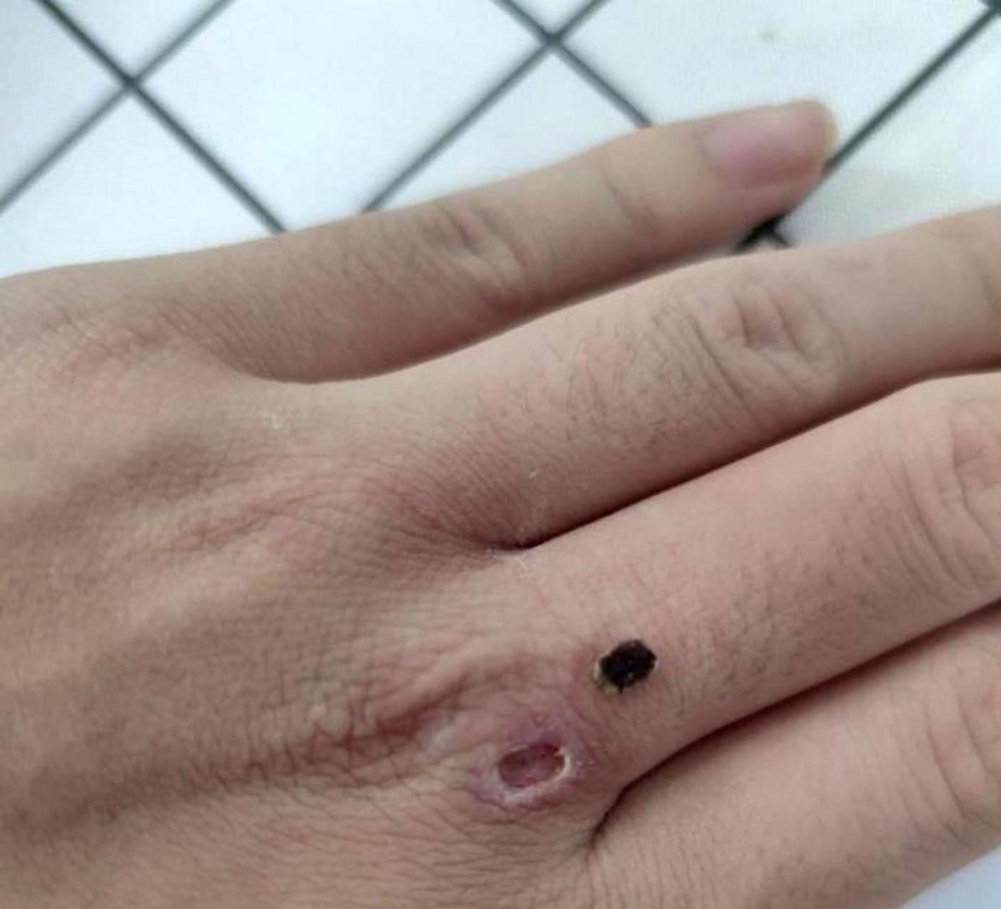 抠出血痂后留下了一个洞,是否需要去医院缝针?